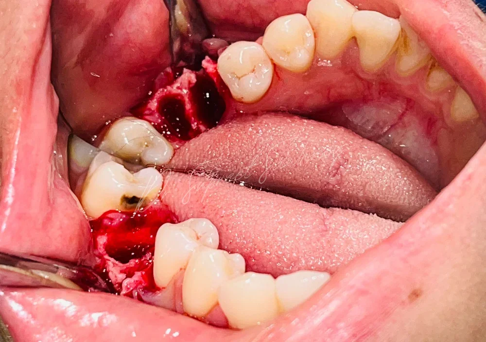 Posterior mandibular surgical site with extraction sockets visible